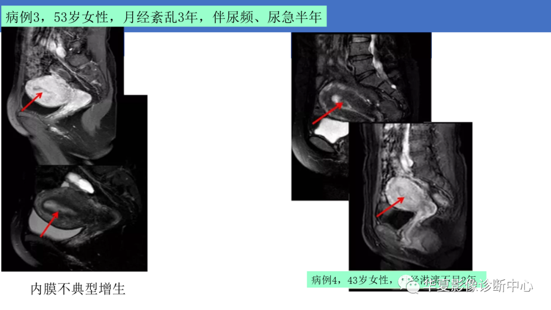影像PPT - 【PPT】子宫内膜疾病的MRI诊断及鉴别-89
