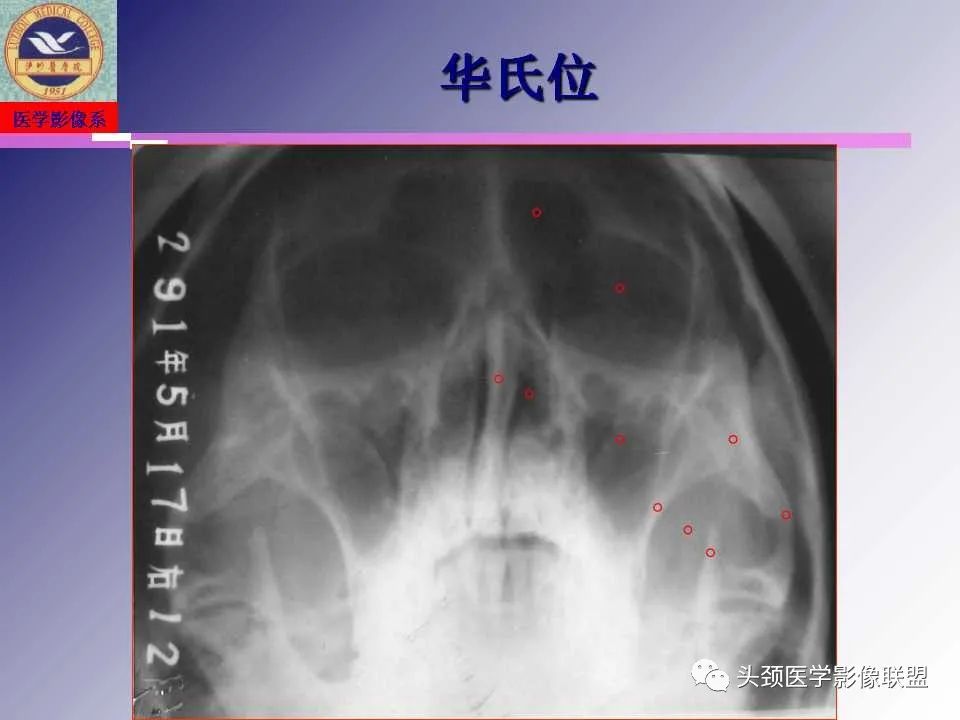 影像PPT - 【PPT】颌面部影像检查方法、正常表现及颌骨骨折影像表现-4