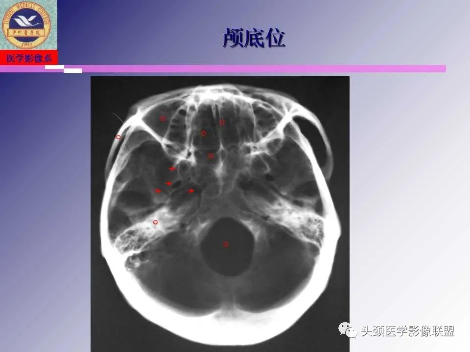 影像PPT - 【PPT】颌面部影像检查方法、正常表现及颌骨骨折影像表现-6