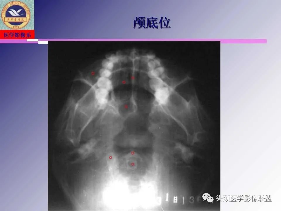影像PPT - 【PPT】颌面部影像检查方法、正常表现及颌骨骨折影像表现-7