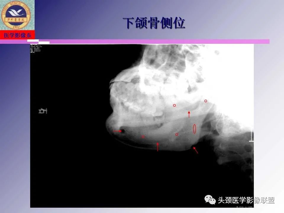影像PPT - 【PPT】颌面部影像检查方法、正常表现及颌骨骨折影像表现-9