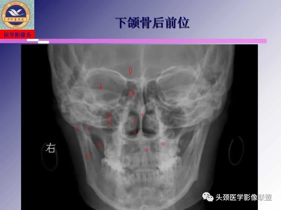 影像PPT - 【PPT】颌面部影像检查方法、正常表现及颌骨骨折影像表现-11