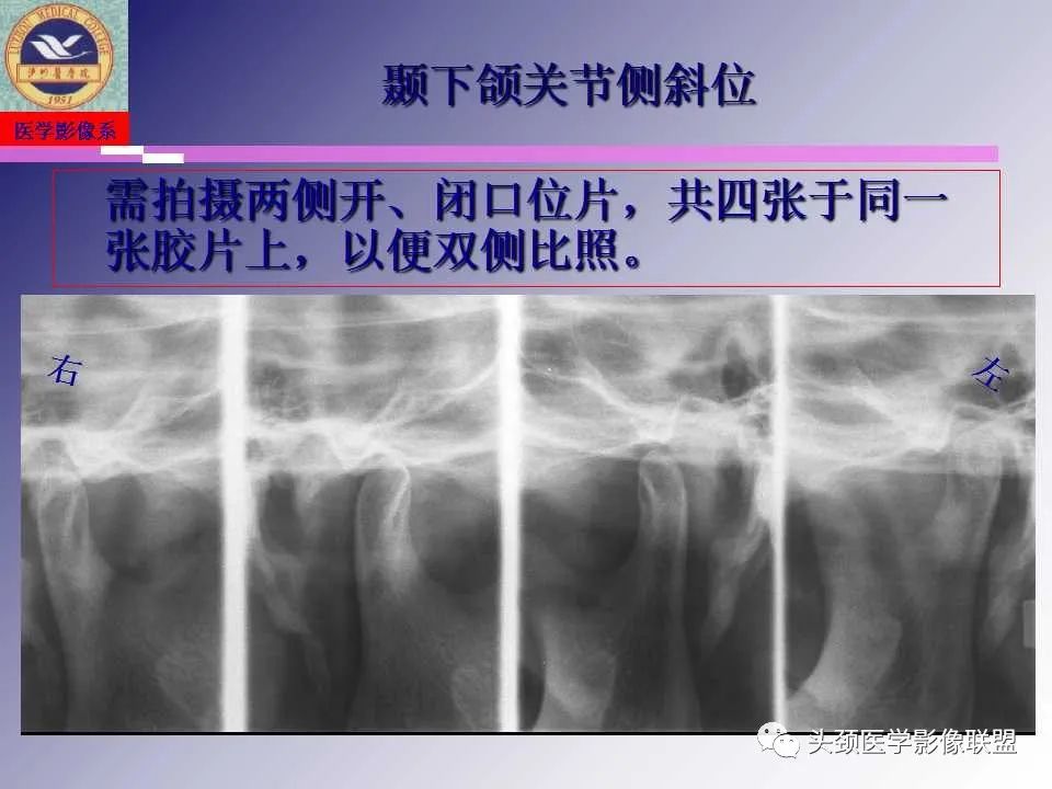 影像PPT - 【PPT】颌面部影像检查方法、正常表现及颌骨骨折影像表现-14