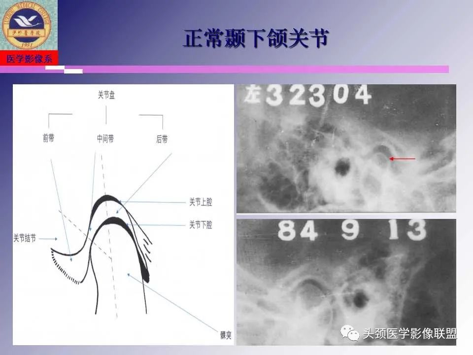 影像PPT - 【PPT】颌面部影像检查方法、正常表现及颌骨骨折影像表现-13