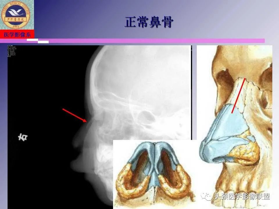 影像PPT - 【PPT】颌面部影像检查方法、正常表现及颌骨骨折影像表现-15