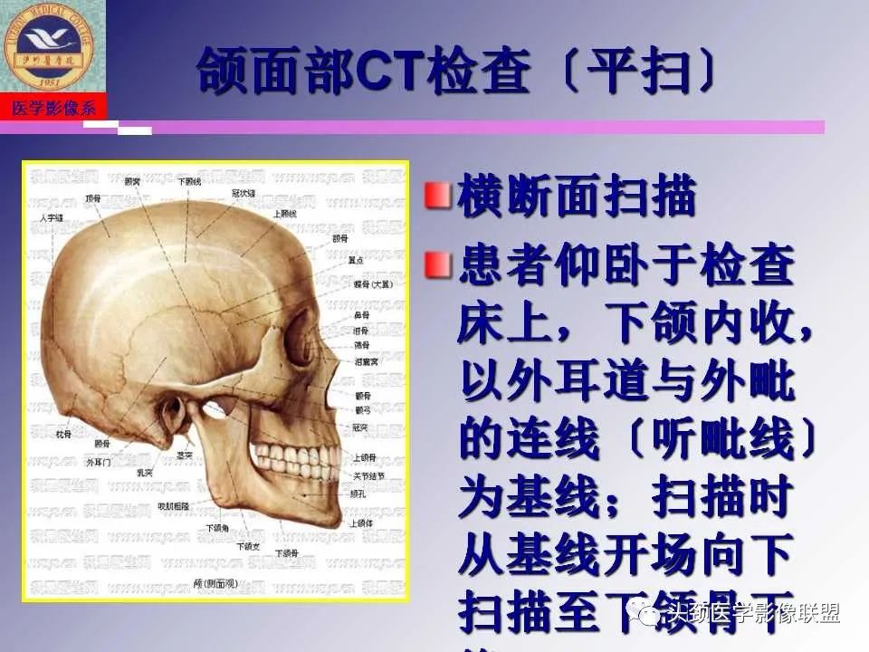 影像PPT - 【PPT】颌面部影像检查方法、正常表现及颌骨骨折影像表现-17