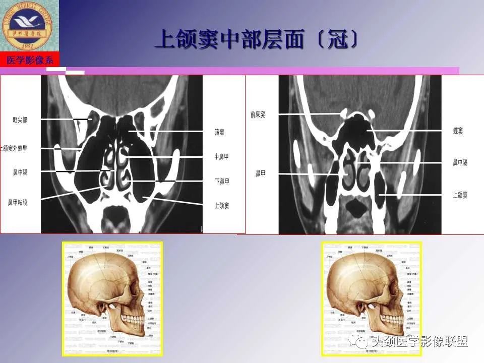 影像PPT - 【PPT】颌面部影像检查方法、正常表现及颌骨骨折影像表现-20
