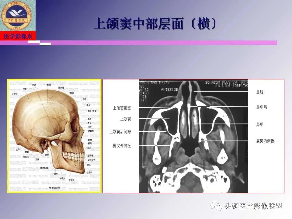 影像PPT - 【PPT】颌面部影像检查方法、正常表现及颌骨骨折影像表现-19