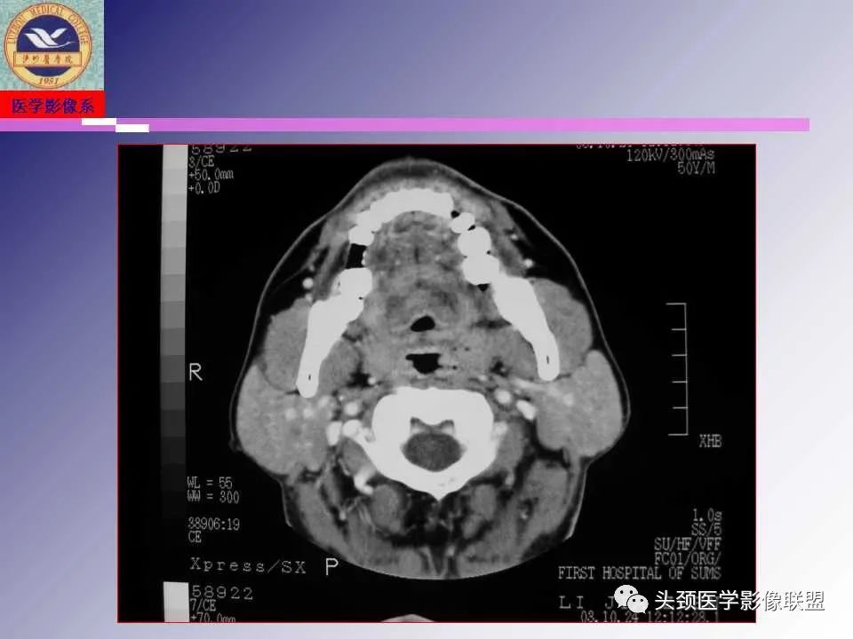 影像PPT - 【PPT】颌面部影像检查方法、正常表现及颌骨骨折影像表现-22