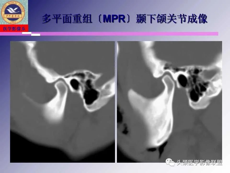 影像PPT - 【PPT】颌面部影像检查方法、正常表现及颌骨骨折影像表现-25