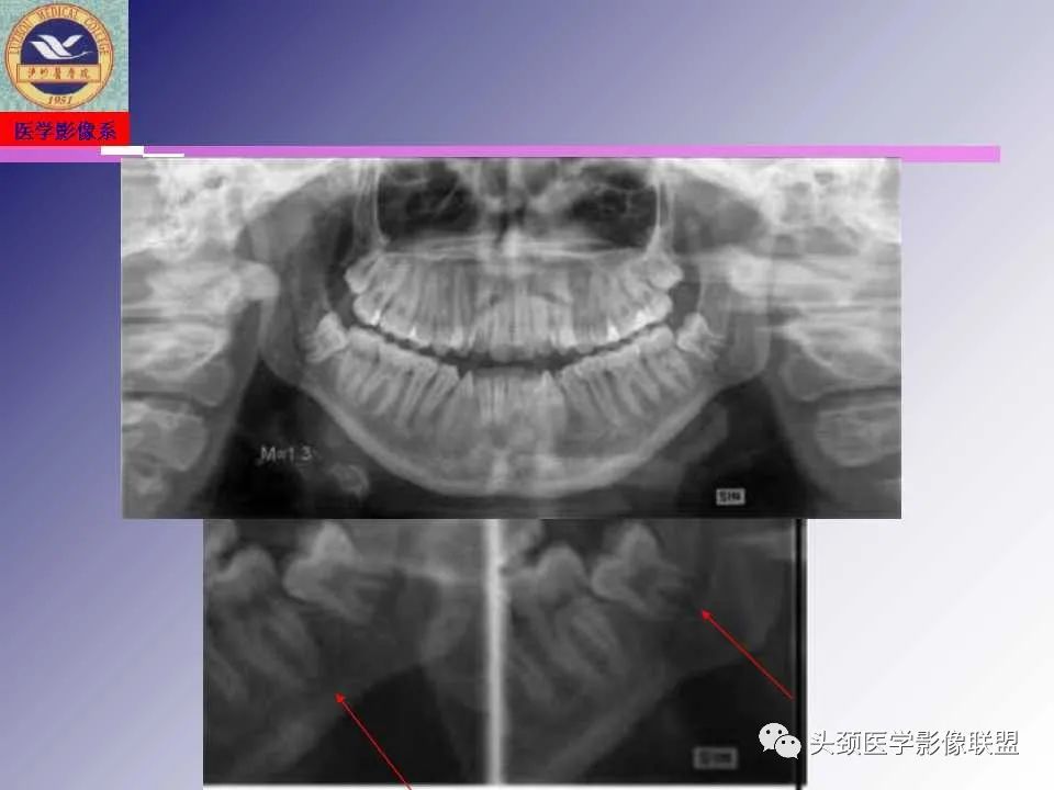 影像PPT - 【PPT】颌面部影像检查方法、正常表现及颌骨骨折影像表现-27