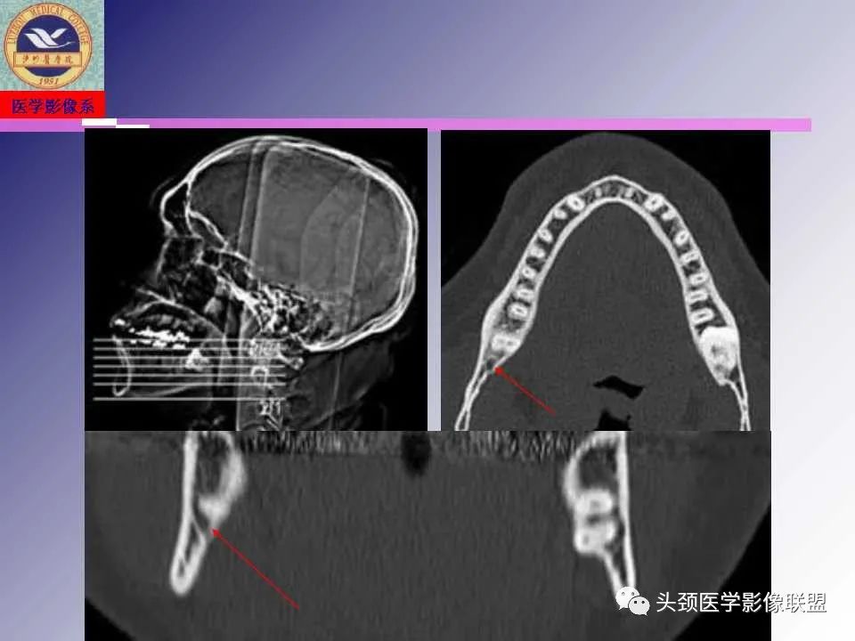 影像PPT - 【PPT】颌面部影像检查方法、正常表现及颌骨骨折影像表现-28