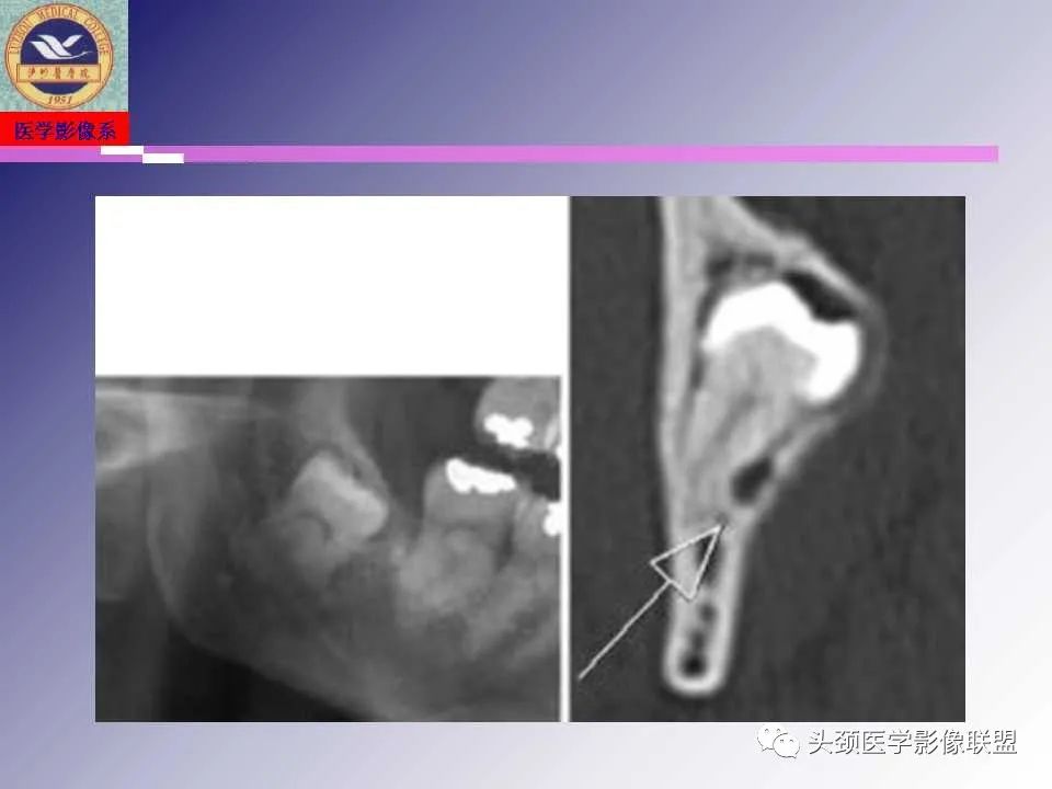 影像PPT - 【PPT】颌面部影像检查方法、正常表现及颌骨骨折影像表现-29