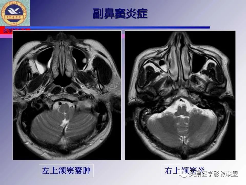 影像PPT - 【PPT】颌面部影像检查方法、正常表现及颌骨骨折影像表现-35