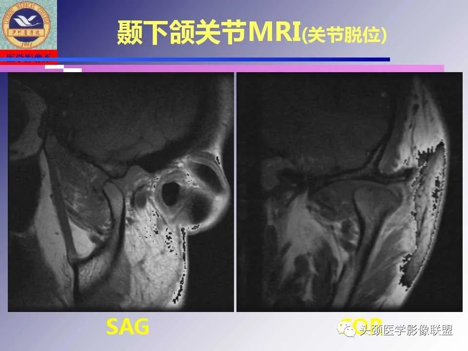 影像PPT - 【PPT】颌面部影像检查方法、正常表现及颌骨骨折影像表现-37