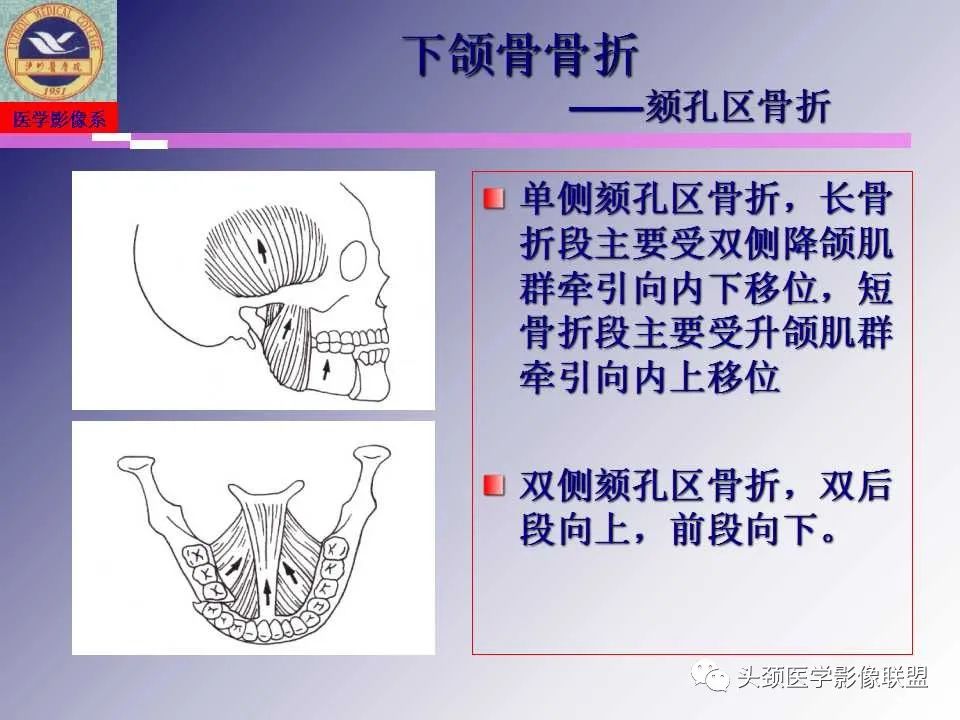 影像PPT - 【PPT】颌面部影像检查方法、正常表现及颌骨骨折影像表现-43