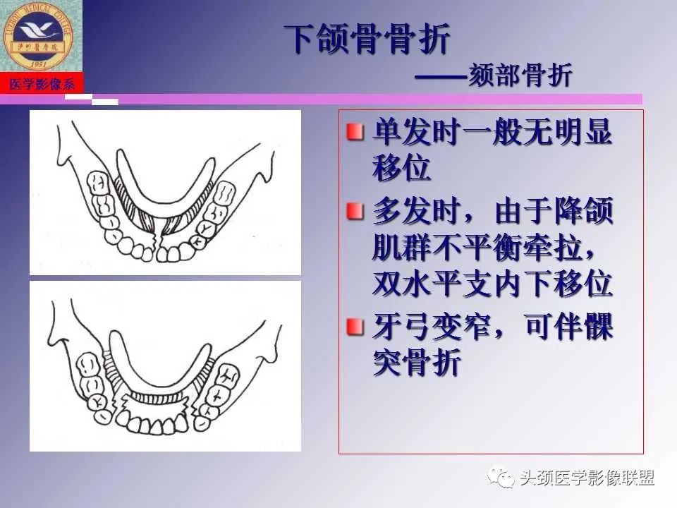 影像PPT - 【PPT】颌面部影像检查方法、正常表现及颌骨骨折影像表现-42