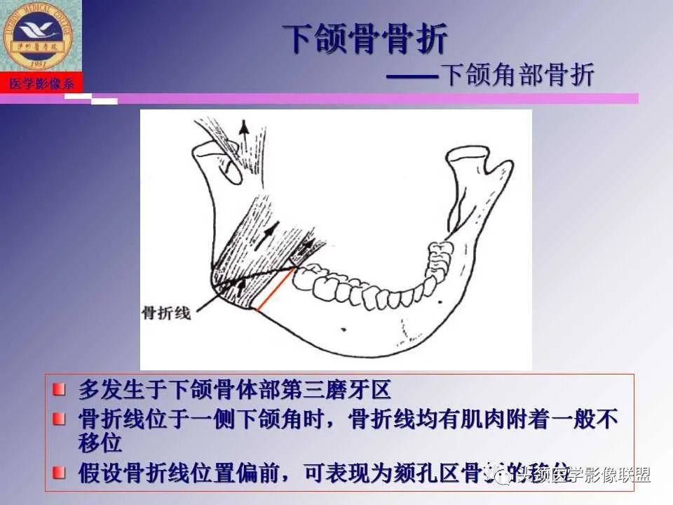 影像PPT - 【PPT】颌面部影像检查方法、正常表现及颌骨骨折影像表现-44