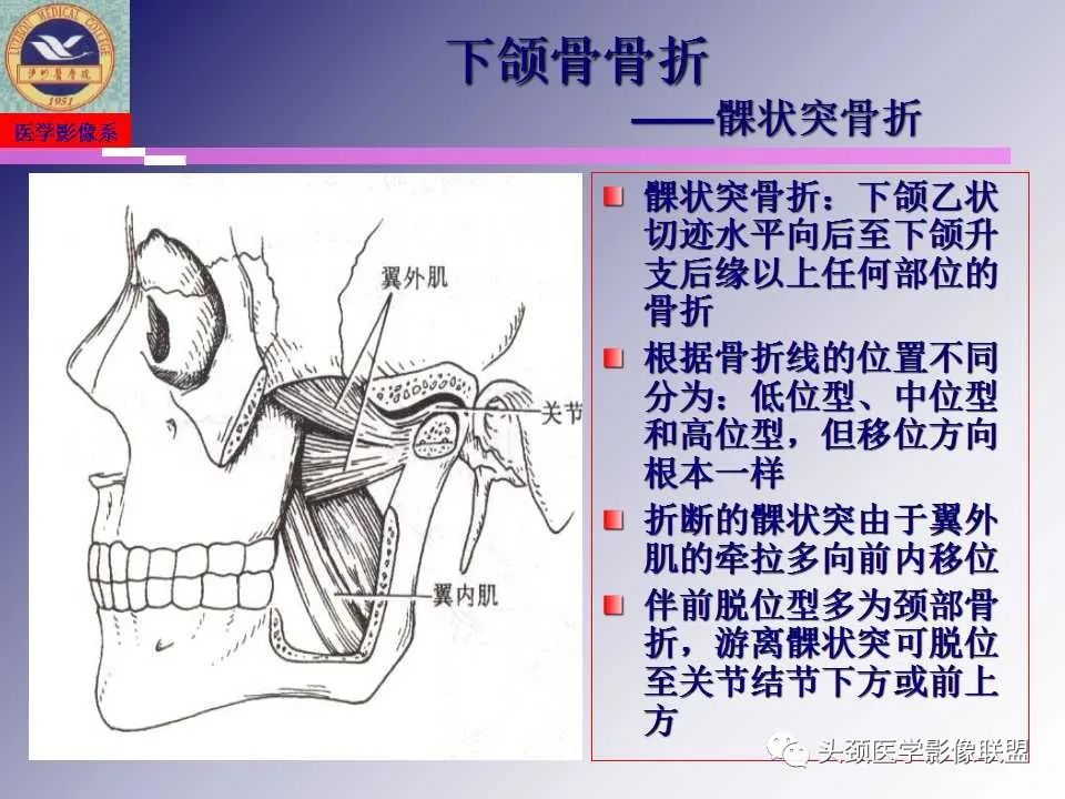 影像PPT - 【PPT】颌面部影像检查方法、正常表现及颌骨骨折影像表现-45