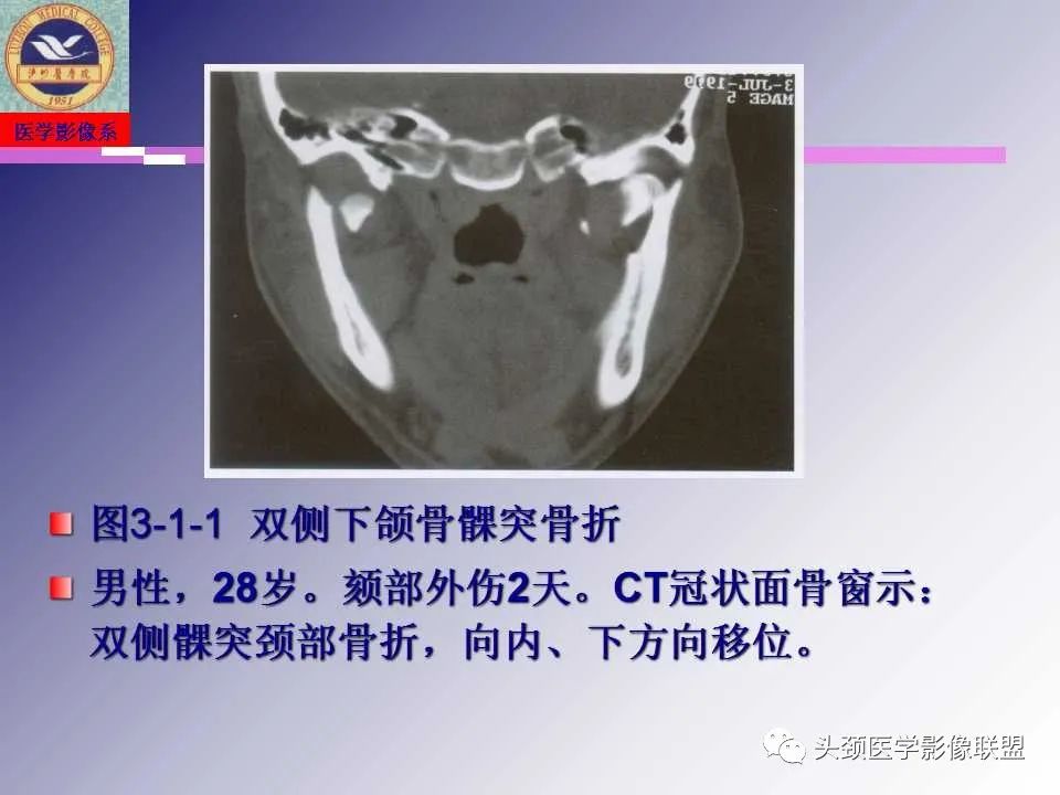 影像PPT - 【PPT】颌面部影像检查方法、正常表现及颌骨骨折影像表现-46