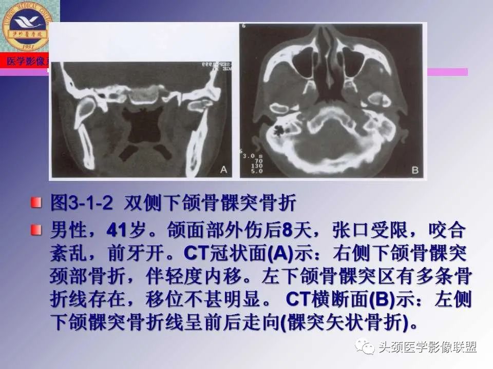 影像PPT - 【PPT】颌面部影像检查方法、正常表现及颌骨骨折影像表现-47