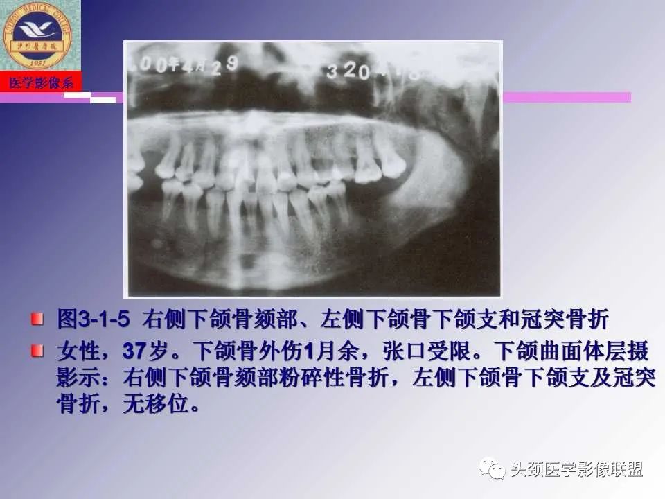 影像PPT - 【PPT】颌面部影像检查方法、正常表现及颌骨骨折影像表现-49
