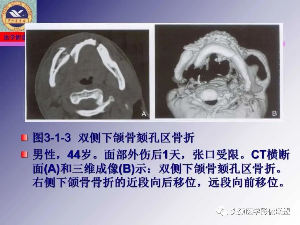 影像PPT - 【PPT】颌面部影像检查方法、正常表现及颌骨骨折影像表现-48