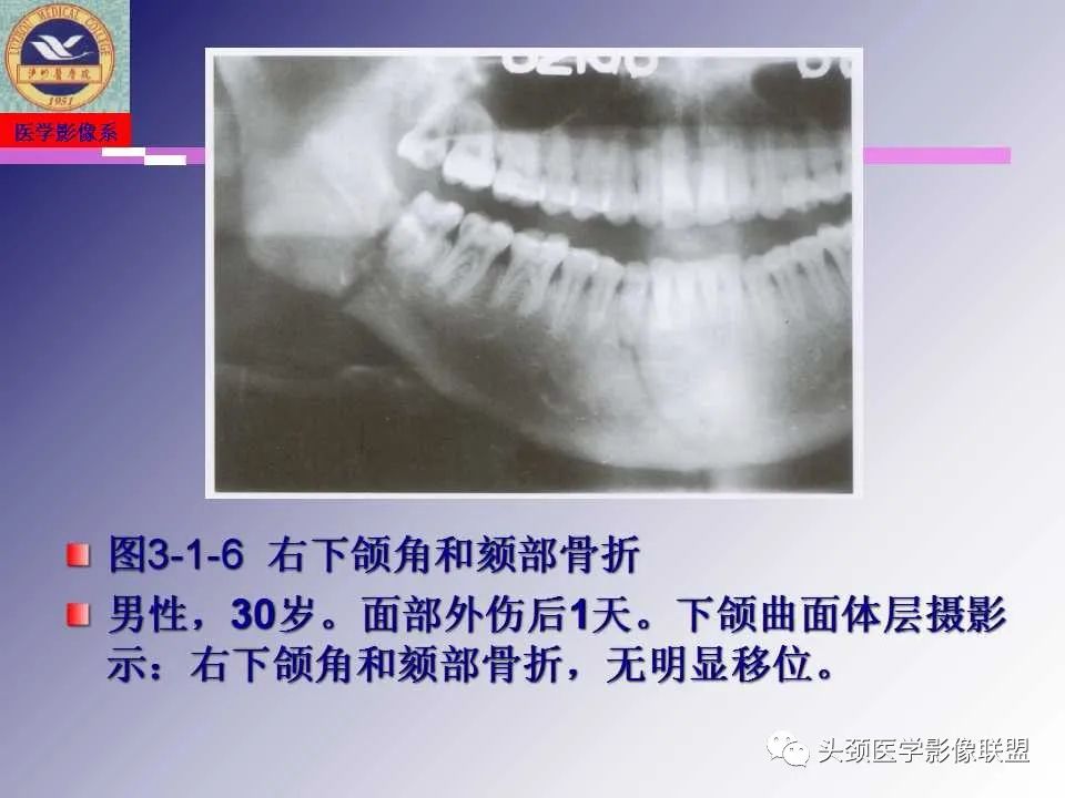 影像PPT - 【PPT】颌面部影像检查方法、正常表现及颌骨骨折影像表现-50