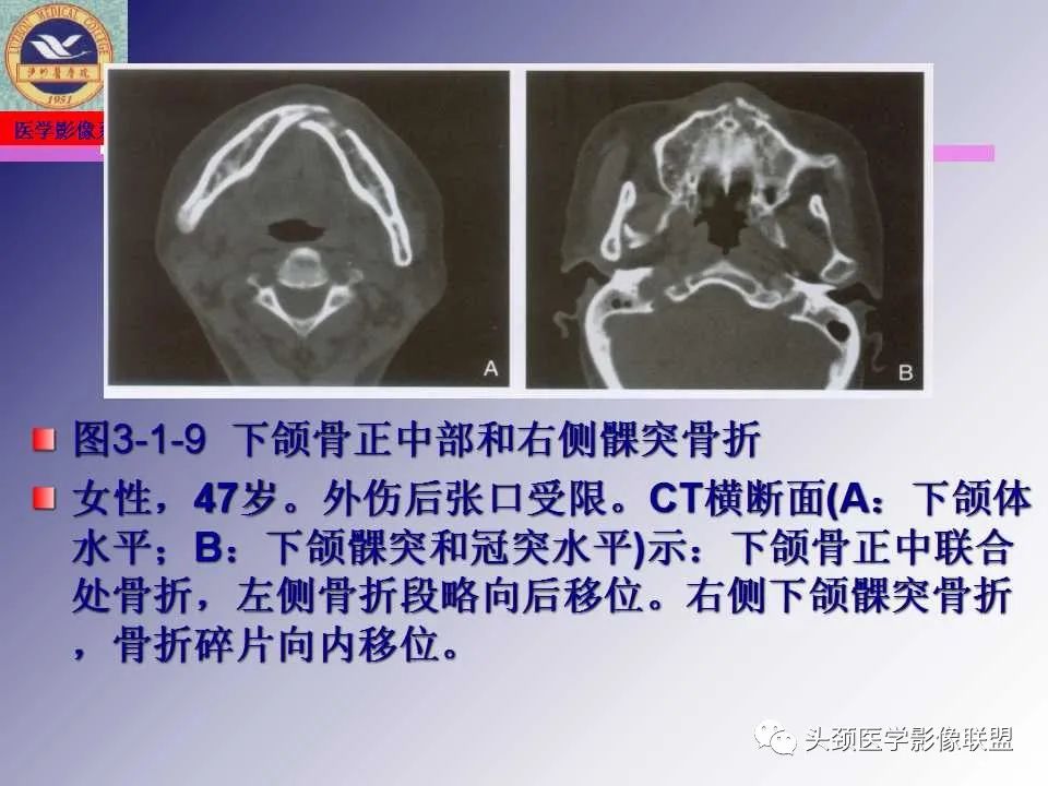 影像PPT - 【PPT】颌面部影像检查方法、正常表现及颌骨骨折影像表现-52