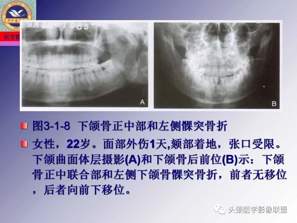 影像PPT - 【PPT】颌面部影像检查方法、正常表现及颌骨骨折影像表现-51