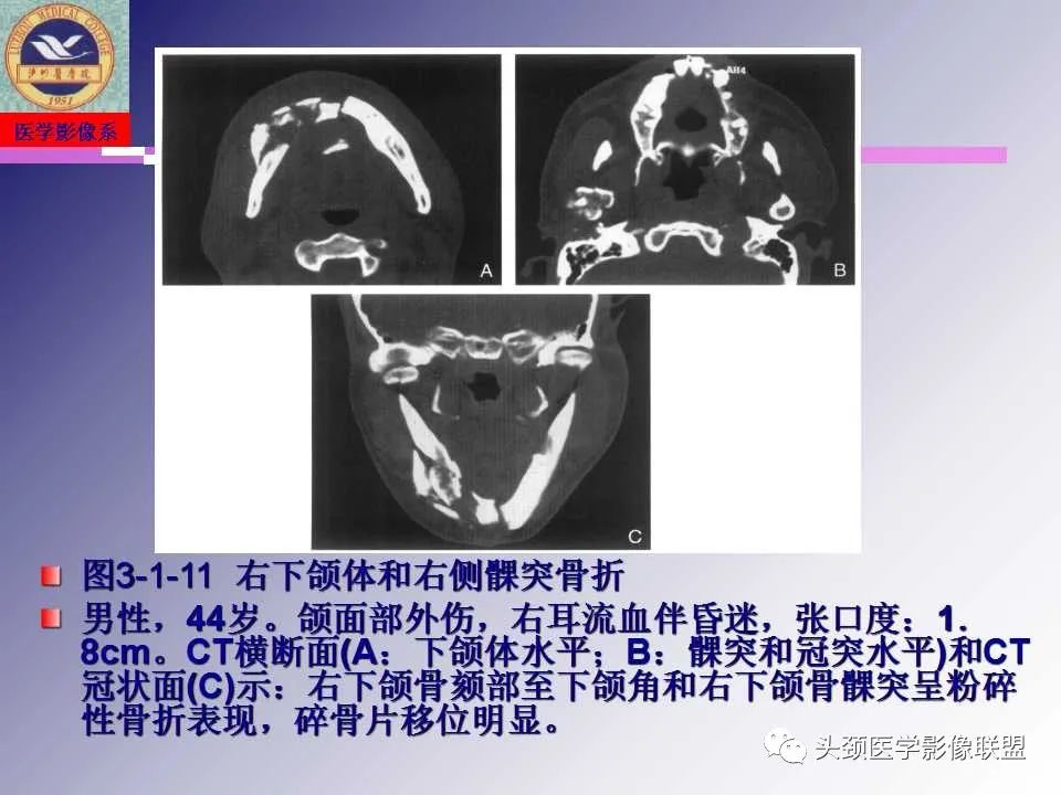影像PPT - 【PPT】颌面部影像检查方法、正常表现及颌骨骨折影像表现-54