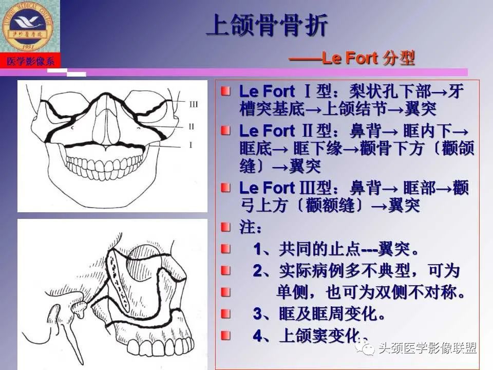 影像PPT - 【PPT】颌面部影像检查方法、正常表现及颌骨骨折影像表现-55