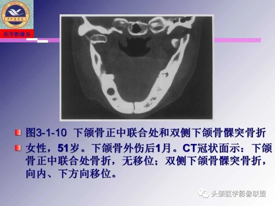 影像PPT - 【PPT】颌面部影像检查方法、正常表现及颌骨骨折影像表现-53