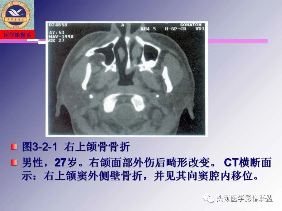 影像PPT - 【PPT】颌面部影像检查方法、正常表现及颌骨骨折影像表现-57