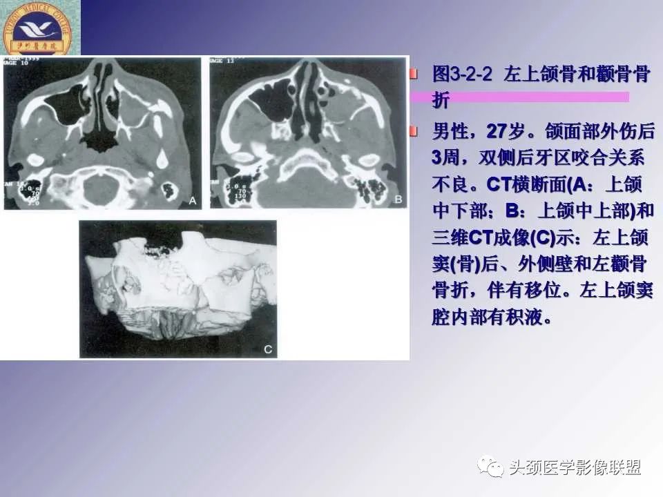 影像PPT - 【PPT】颌面部影像检查方法、正常表现及颌骨骨折影像表现-58