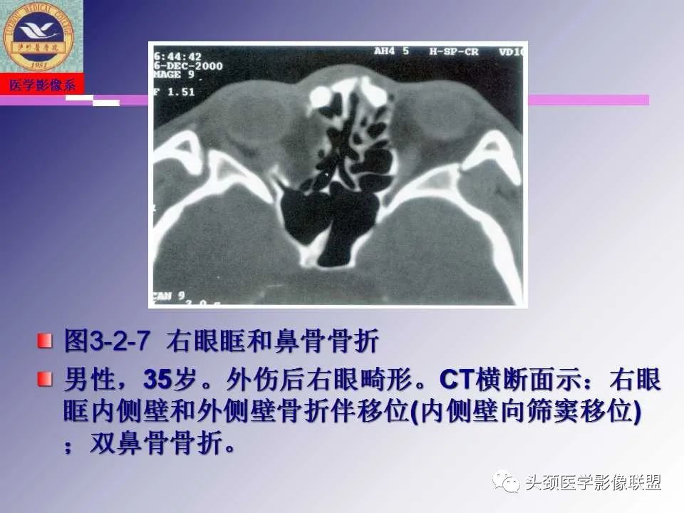 影像PPT - 【PPT】颌面部影像检查方法、正常表现及颌骨骨折影像表现-60