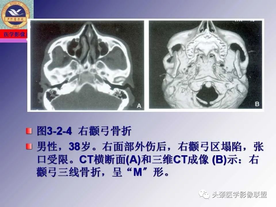 影像PPT - 【PPT】颌面部影像检查方法、正常表现及颌骨骨折影像表现-59