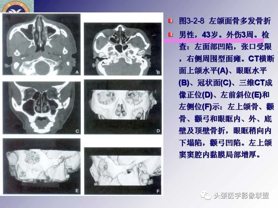 影像PPT - 【PPT】颌面部影像检查方法、正常表现及颌骨骨折影像表现-61