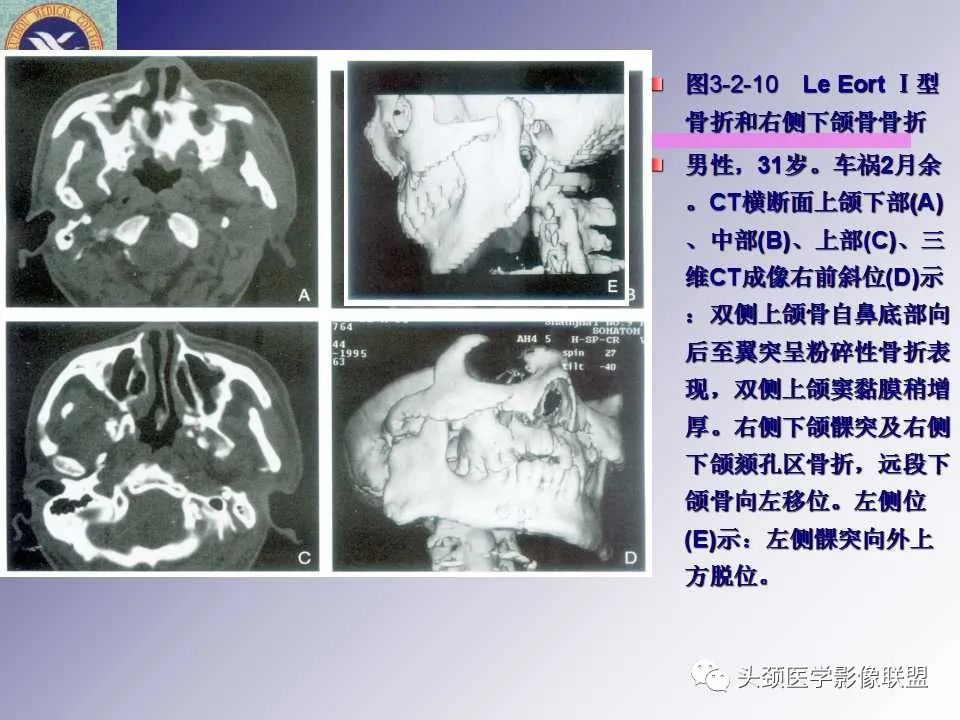 影像PPT - 【PPT】颌面部影像检查方法、正常表现及颌骨骨折影像表现-62