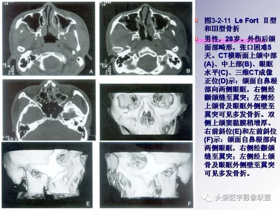 影像PPT - 【PPT】颌面部影像检查方法、正常表现及颌骨骨折影像表现-63
