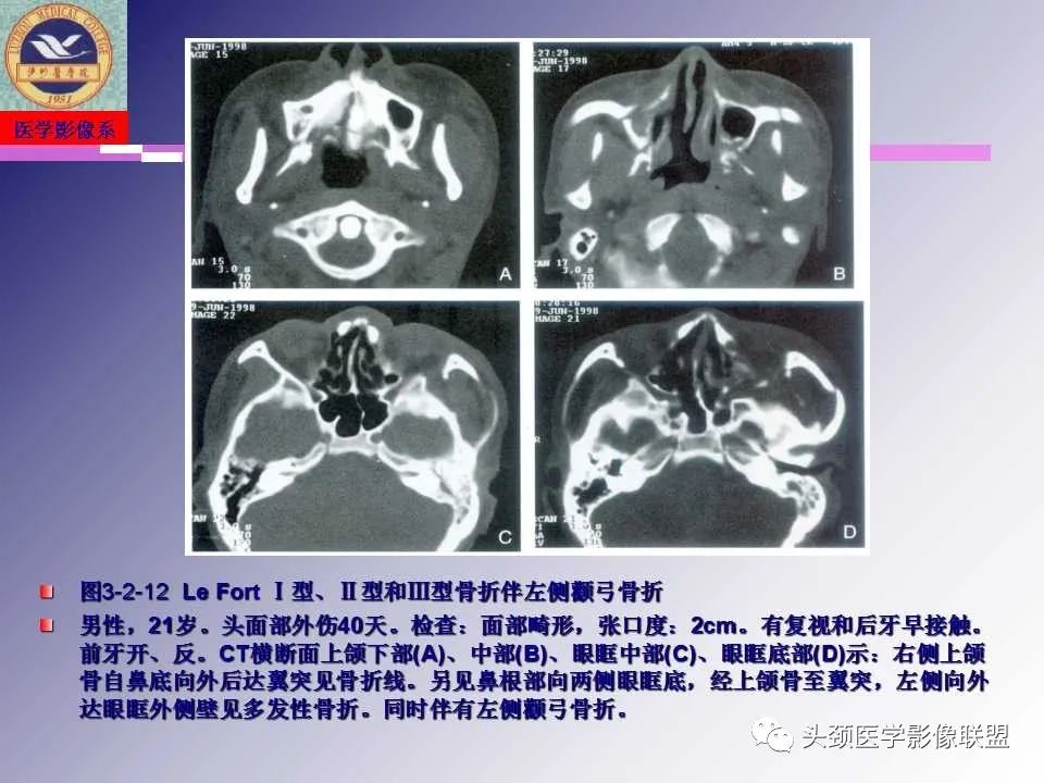 影像PPT - 【PPT】颌面部影像检查方法、正常表现及颌骨骨折影像表现-64