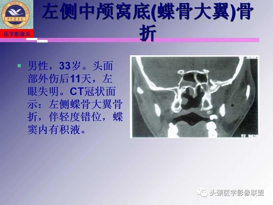 影像PPT - 【PPT】颌面部影像检查方法、正常表现及颌骨骨折影像表现-65