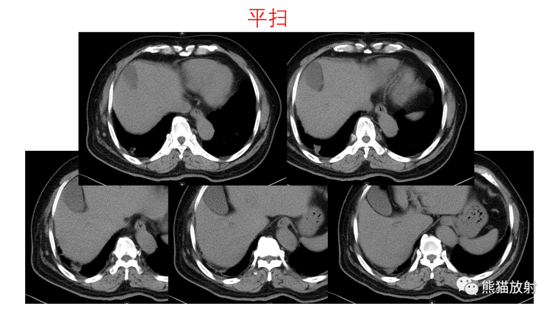 影像PPT - 【病例】支气管腺瘤2例CT影像-4