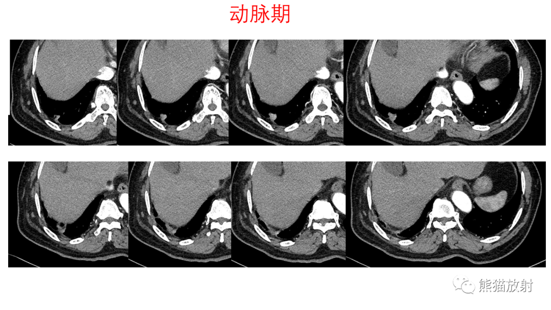 影像PPT - 【病例】支气管腺瘤2例CT影像-5
