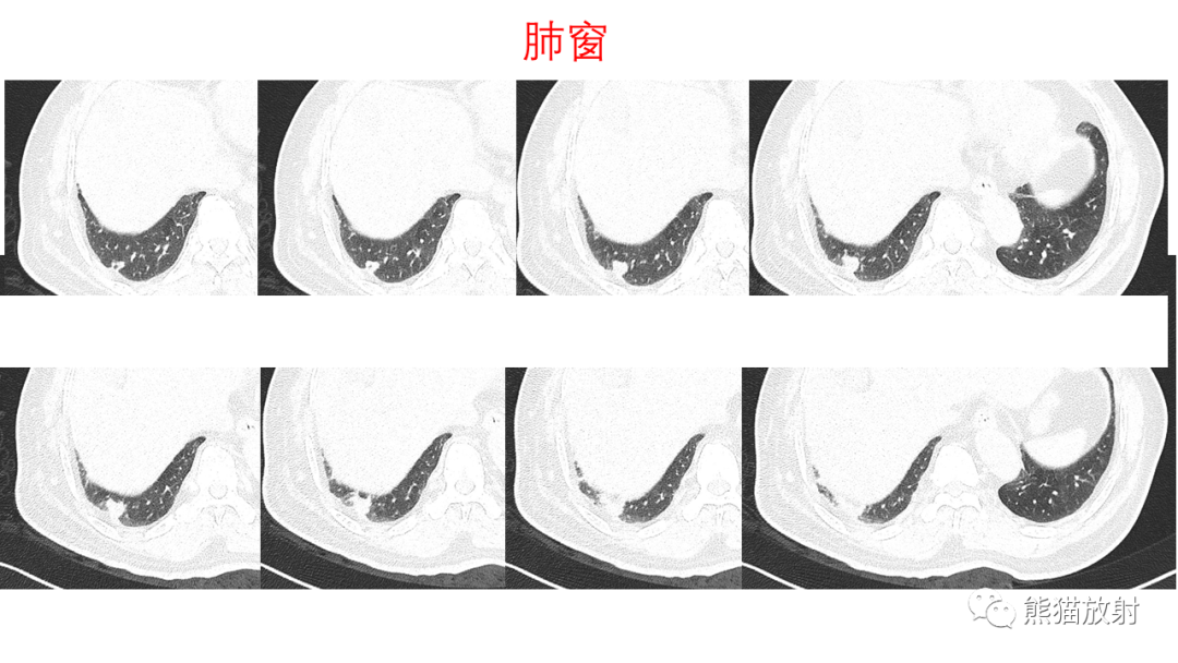 影像PPT - 【病例】支气管腺瘤2例CT影像-3