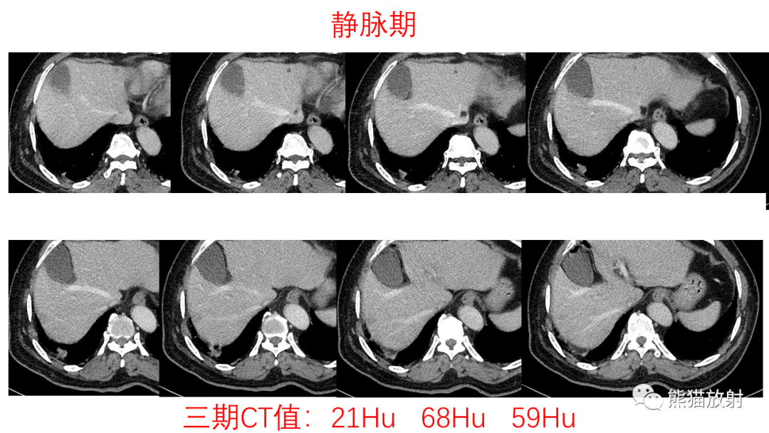影像PPT - 【病例】支气管腺瘤2例CT影像-6
