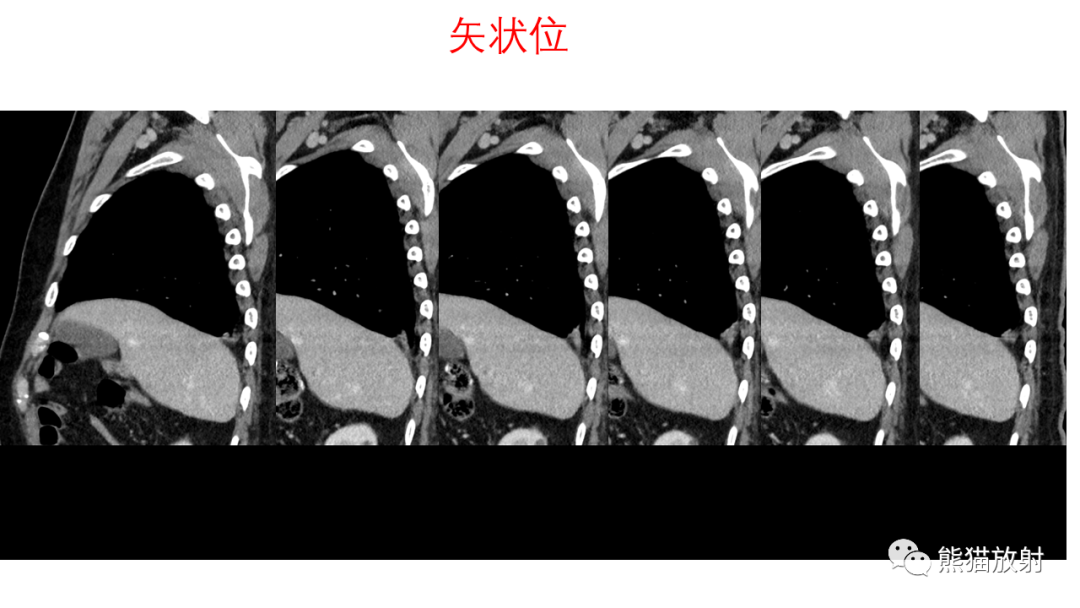 影像PPT - 【病例】支气管腺瘤2例CT影像-8