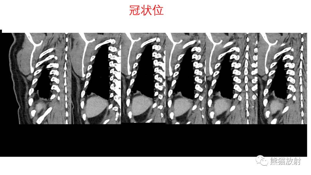 影像PPT - 【病例】支气管腺瘤2例CT影像-7