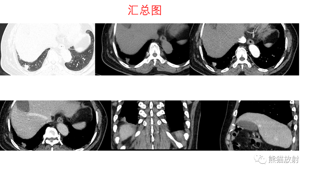 影像PPT - 【病例】支气管腺瘤2例CT影像-9