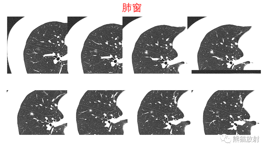 影像PPT - 【病例】支气管腺瘤2例CT影像-12